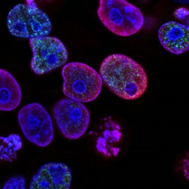 ovarian cancer cells
